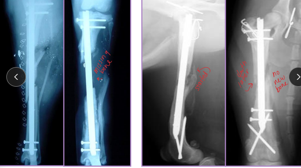 <ul><li><p><span style="background-color: transparent;"><strong><span>Dt:</span></strong><span> </span><u><span>Take </span></u></span><span style="background-color: transparent; color: red;"><u><span>xrays every 4-6 weeks postop** compare pre/post op</span></u></span></p></li><li><p><span style="background-color: transparent;"><strong><span>Delayed Union: </span></strong></span><span style="background-color: transparent; color: green;"><span>Healing </span><u><span>slower than expected</span></u></span><span style="background-color: transparent;"><span>, but evidence of healing present</span></span></p><ul><li><p><span style="background-color: transparent;"><strong><span>Tx:</span></strong><span> wait, bone graft, stabilize, remove loose implants</span></span></p></li></ul></li><li><p><span style="background-color: transparent;"><strong><span>Nonunion:</span></strong></span><span style="background-color: transparent; color: green;"><strong><span> </span></strong><span>No progression on rads for 3+ months</span></span><span style="background-color: transparent;"><span>, </span><strong><u><span>i</span></u></strong><u><span>nstability, poor blood supply</span></u></span></p><ul><li><p><span style="background-color: transparent;"><strong><span>Vascular (viable):</span></strong><span> </span></span><span style="background-color: transparent; color: green;"><span>callus present</span></span><span style="background-color: transparent;"><span>, fracture line persists</span></span></p><ul><li><p><span style="background-color: transparent;"><strong><span>Tx: </span></strong><span>stabilize, remove implants, align</span></span></p></li></ul></li><li><p><span style="background-color: transparent;"><strong><span>Avascular (non-viable):</span></strong></span><span style="background-color: transparent; color: green;"><span> little/no callus</span></span><span style="background-color: transparent;"><span>, poor biology </span></span></p><ul><li><p><span style="background-color: transparent;"><strong><span>Tx: </span></strong><span>curettage, rigid fixation, cancellous graft, remove loose implants</span></span></p></li></ul></li></ul></li></ul><ul><li><p><span style="background-color: transparent;"><strong><span>Malunion: </span></strong><span>Fracture healed in </span></span><span style="background-color: transparent; color: green;"><span>abnormal alignment</span></span></p><ul><li><p><span style="background-color: transparent;"><strong><span>Varus:</span></strong><span> distal limb </span></span><span style="background-color: transparent; color: green;"><span>deviates medially</span></span><span style="background-color: transparent;"><span>: elbow/knee away</span></span></p></li><li><p><span style="background-color: transparent;"><strong><span>Valgus:</span></strong><span> distal limb </span></span><span style="background-color: transparent; color: green;"><span>deviates laterally:</span></span><span style="background-color: transparent;"><span> elbow/knees touching</span></span></p></li><li><p><span style="background-color: transparent;"><strong><span>Torsion:</span></strong><span> bone rotated on </span><strong><span>long axis</span></strong></span></p></li><li><p><span style="background-color: transparent;"><strong><span>Translation:</span></strong><span> displacement, longitudinal axis intact</span></span></p></li><li><p><span style="background-color: transparent;"><strong><span>Recurvatum:</span></strong><span> apex caudal, distal limb cranial to fracture </span></span></p></li><li><p><span style="background-color: transparent;"><strong><span>Procurvatum (antecurvatum):</span></strong><span> apex cranial, distal limb caudal to fracture</span></span></p></li></ul></li><li><p><span style="background-color: transparent;"><strong><span>Wolff’s Law:</span></strong><span> bone remodels </span><strong><span>along stress lines </span></strong></span></p><ul><li><p><span style="background-color: transparent;"><span>explains partial correction of malunion</span></span></p></li></ul></li></ul><p></p>