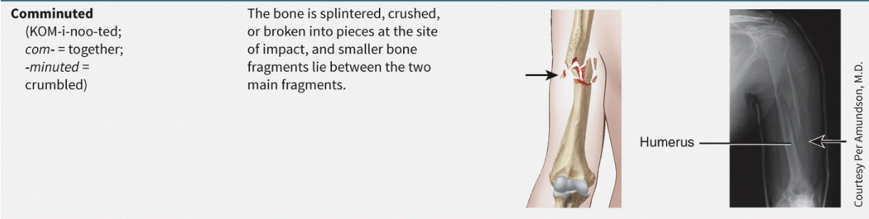 <p>Multiple fragments due to crash injury</p>