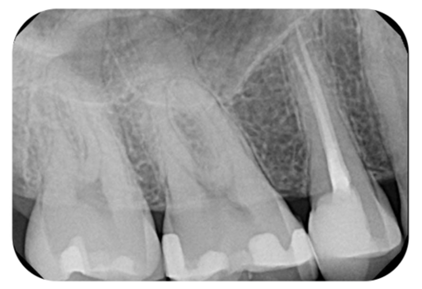 <p>What are the radiographic findings on #4?</p>