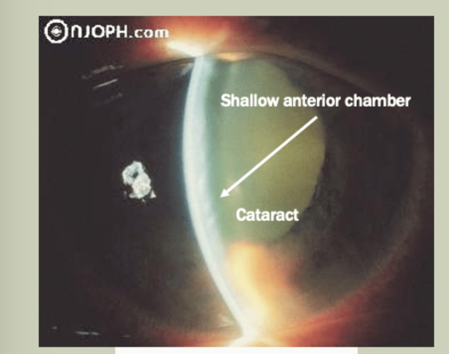 <p>-Unilateral in older pts due to closure of drainage system</p><p>-SX: red eye with pain, blurred vision, may have headache/vomiting</p><p>-Signs: Pupil rxns is sluggish, hazy cornea, elevated IOP&gt;30 mmHg</p><p>-TX: Refer to ECP STAT for Laser Peripheral Iridotomy (LPI)</p>