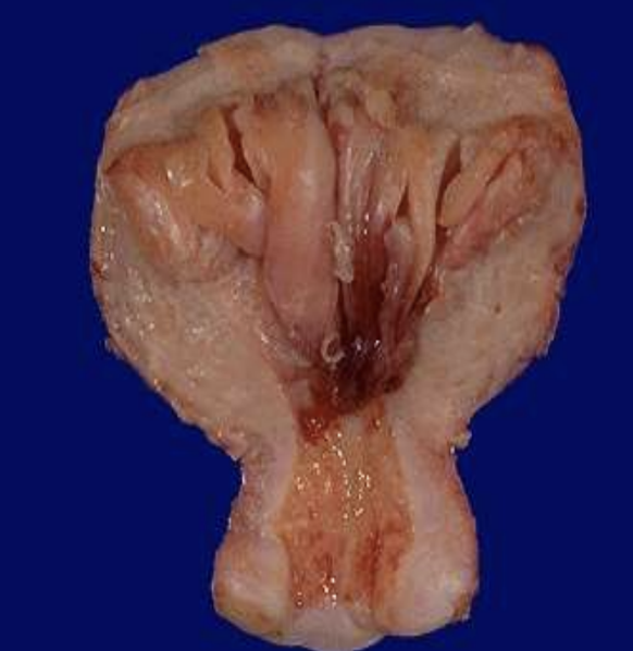 <p>Endometrial Hyperplasia</p>