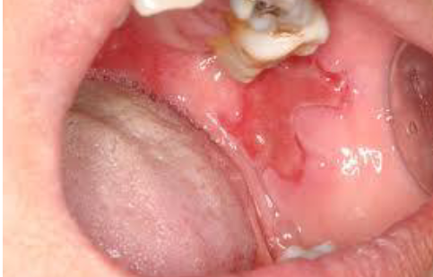 <p>What autoimmune disease targets desmosomes?</p>