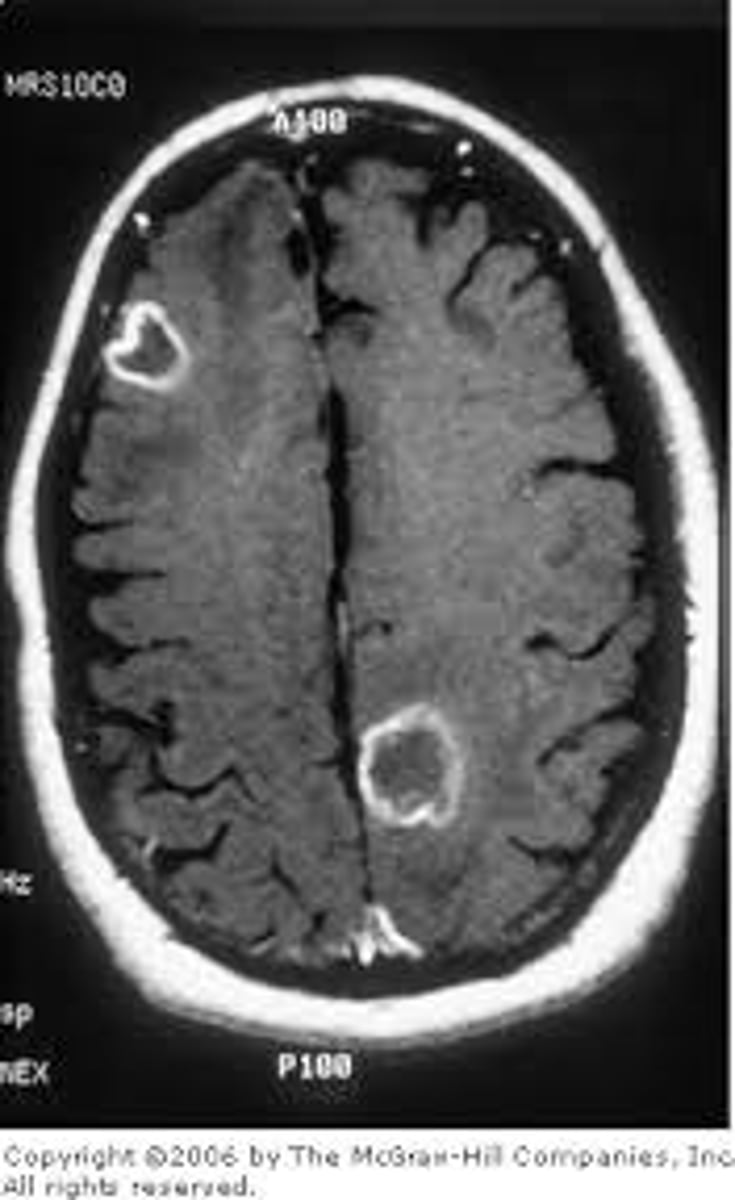 <p>damage to a part of the brain that results in destruction to the neurons; can be natural (like brain injury or disease) or deliberate (surgery)</p>
