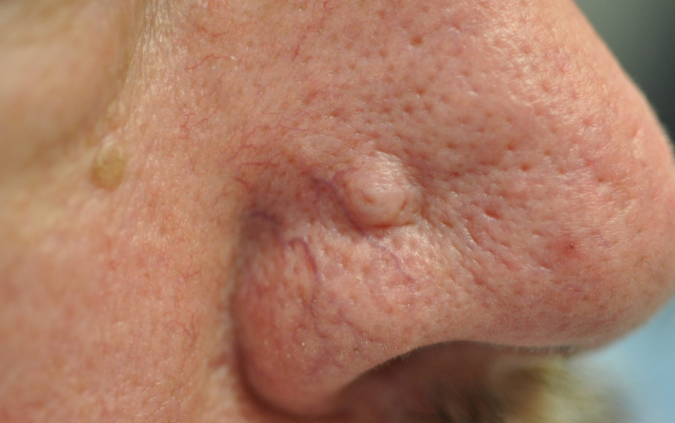 <p>A raised, defined, solid bump under the skin </p>