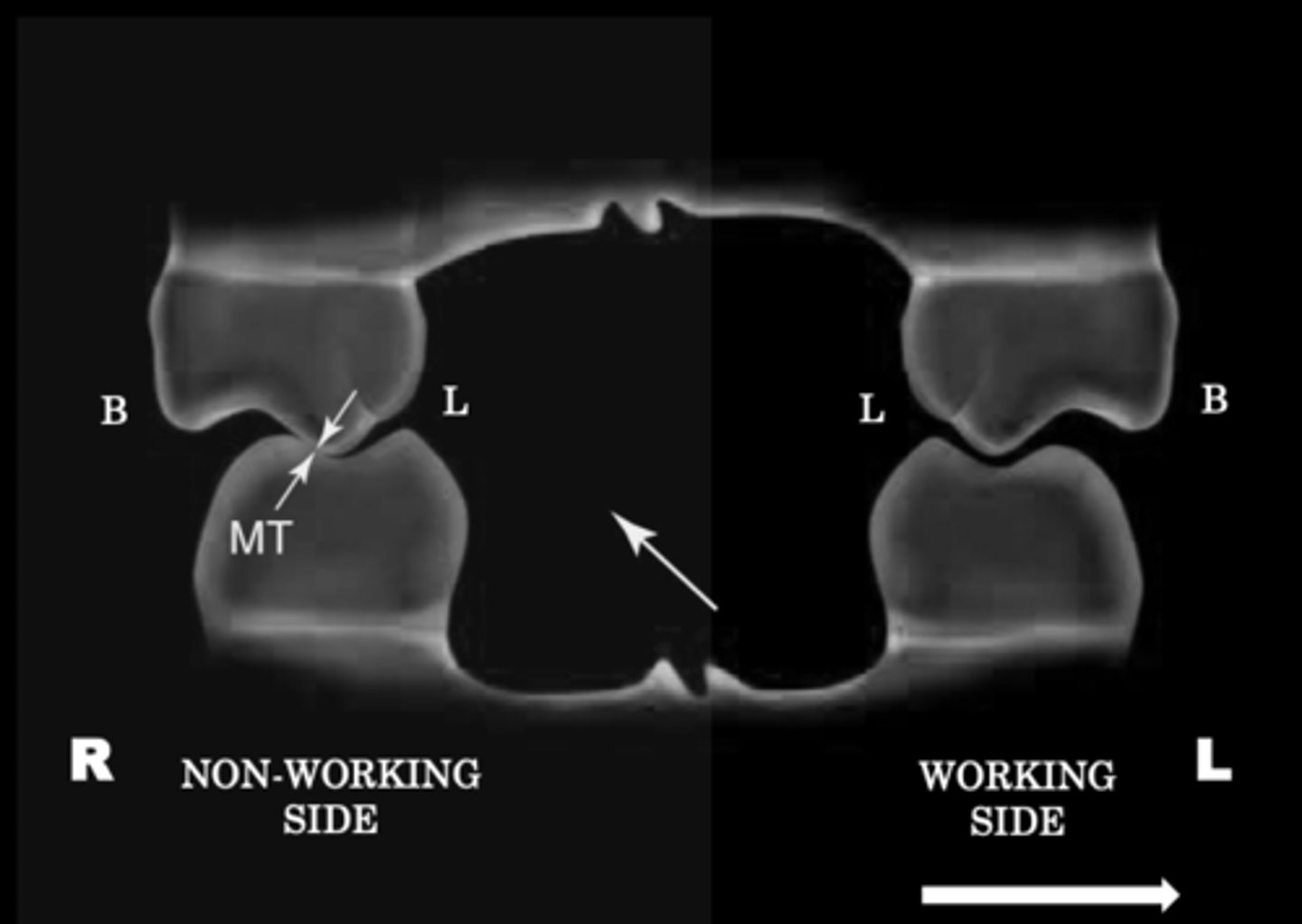 <p>Usually found at inner incline of maxillary lingual cusps against inner incline mandibular buccal cusp</p>