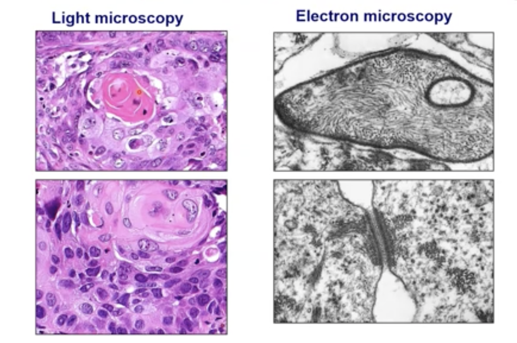 What does squamous cell carcinoma look like in the lung and what is the major cause ? What category of carcinoma does it fall under? 