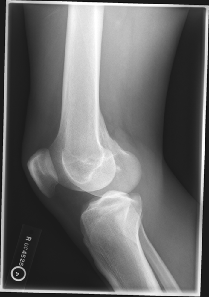<p>what is the image critique for this lateral knee?</p>