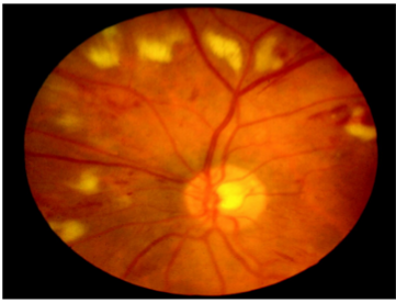 <ul><li><p><strong>Yellow/white </strong>superficial retinal lesions with indistinct <strong>feathery borders</strong></p></li><li><p>Represent areas of edema within the retinal nerve fiber layer due to focal ischemia</p></li></ul><p></p>