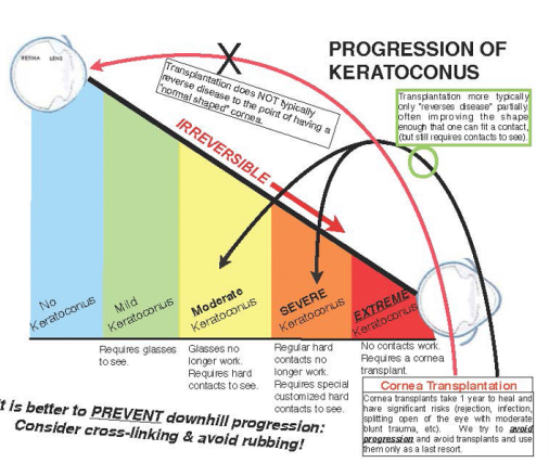 <p>FALSE - impossible</p><ul><li><p>typically progresses over 3-8 years</p></li></ul>