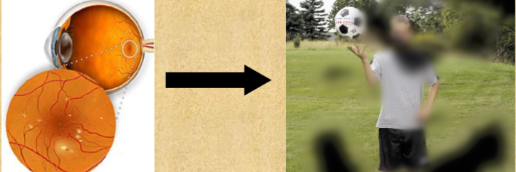 <p>Complication of diabetes. Retinal</p><p>vessels weaken, leaking blood and fluid into vitreous.</p><p>Glaucoma (pressure, creating restricted VF’s) cataracts</p><p>(clouding of the lens), retinal detachment, floaters and clouding</p><p>of the vitreous may occur.</p>