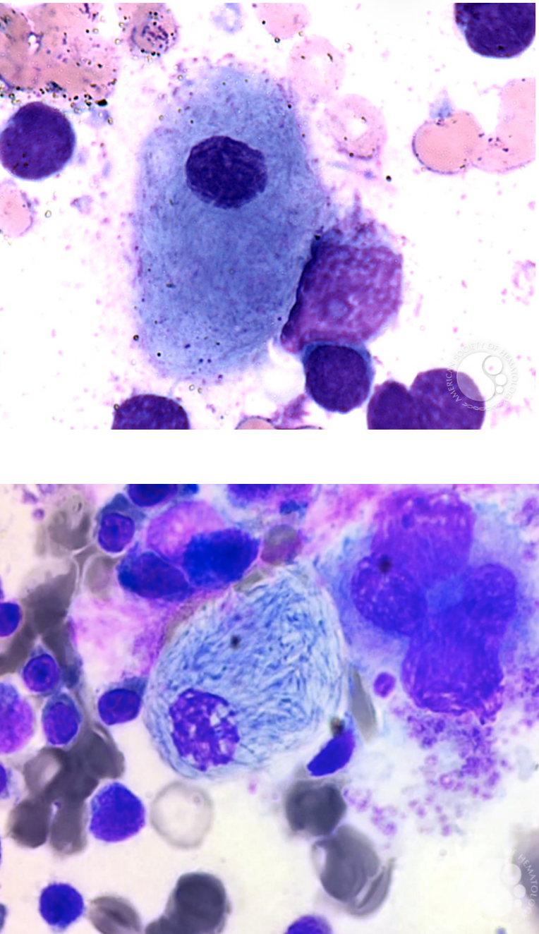 <p>● Seen in patients with thalassemia, myeloid neoplasm,</p><p>ALL, non-Hodgkin lymphoma, and plasma cell neoplasm</p><p>● Seen on cancer patients</p><p>● Composition: needle-like inclusion</p>