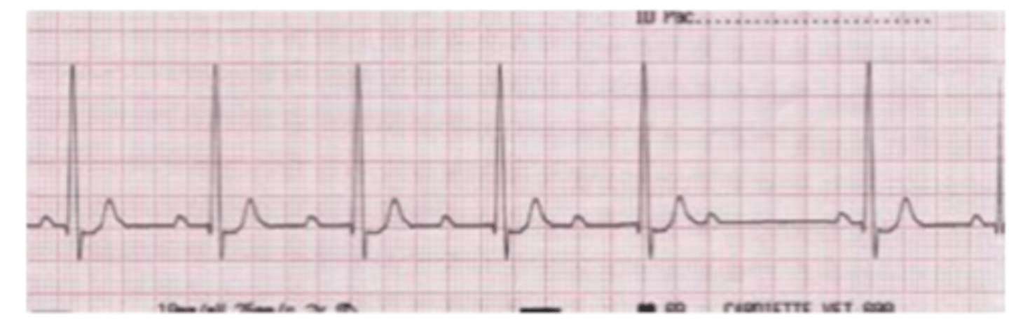 <p>what type of arrhythmia do we see here?</p>