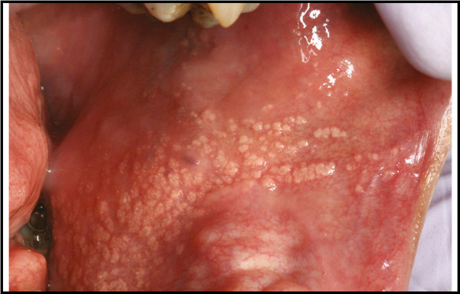 <p>give an example of ectopia in the oral cavity </p>