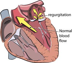 <p>Regurgitation</p>