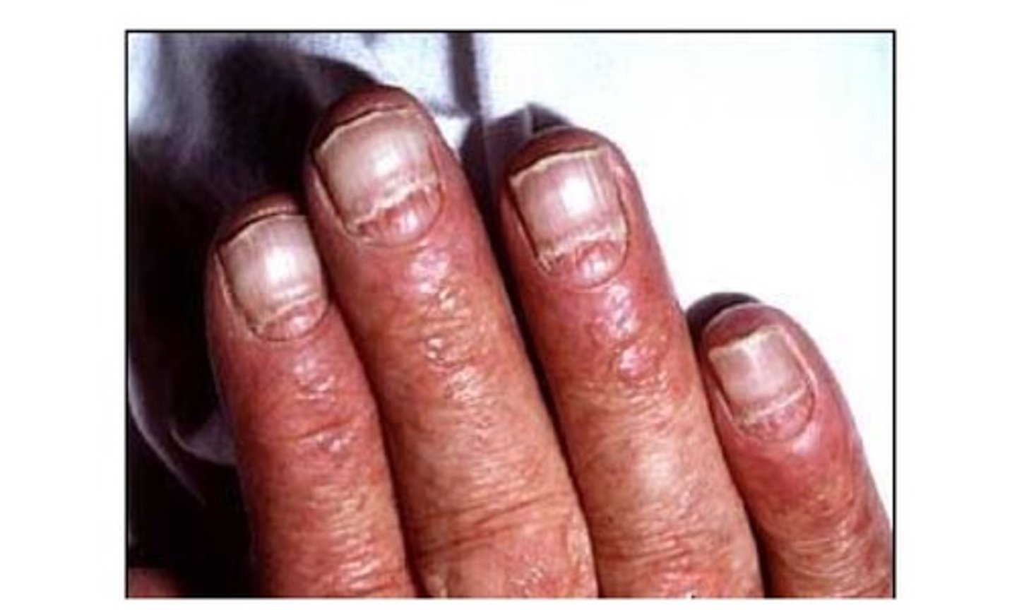 <p>envenenamiento de la sangre (septicemia)</p>