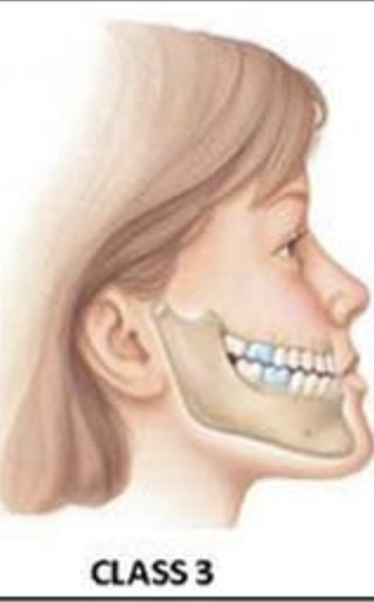 <p>The first molar of the lower jaw is anterior to the normal position</p>