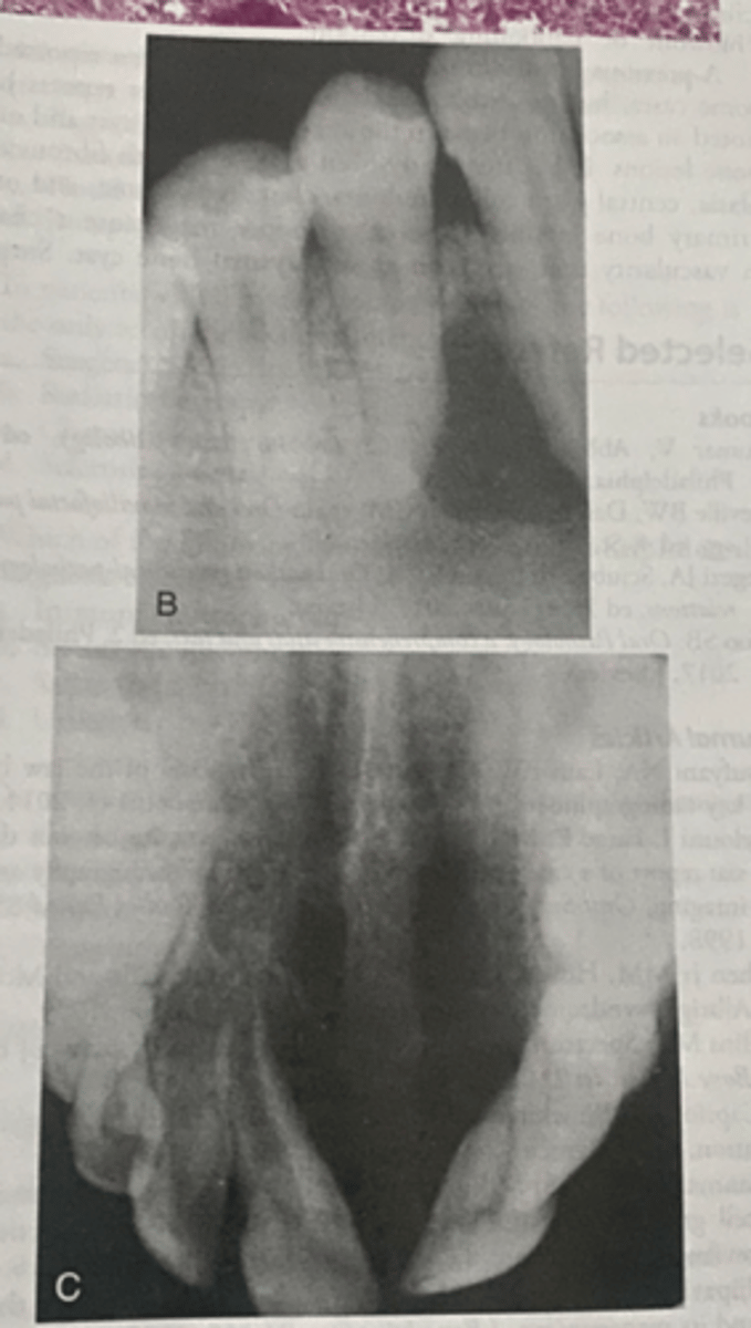 <p>-may occur on the gingiva or alveolar ridge or in the maxilla or mandible</p><p>-divergence of the root of adjacent teeth is a common feature</p>