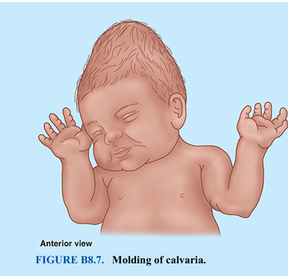 <p>The bones of the calvaria and some parts of the cranial base develop by intramembranous ossification. Most parts of the cranial base develop by endochondral ossification. At birth, the bones of the calvaria are smooth and unilaminar; no diploë is present. The frontal and parietal eminences are especially prominent (Fig. B8.6). The cranium of a neonate is disproportionately large compared to other parts of the skeleton; however, the facial aspect is small compared to the calvaria, which forms approximately one eighth of the cranium. In the adult, the facial skeleton forms one third of the cranium. The large size of the calvaria in infants results from precocious growth and development of the brain and eyes.</p><p>The rudimentary development of the face makes the orbits appear relatively large (Fig. B8.6A). The smallness of the face results from the rudimentary development of the maxillae, mandible, and paranasal sinuses (air-filled bone cavities), the absence of erupted teeth, and the small size of the nasal cavities.</p><p>The halves of the frontal bone in the neonate are separated by the frontal suture, the frontal and parietal bones are separated by the coronal suture, and the maxillae and mandibles are separated by the intermaxillary suture and mandibular symphysis (secondary cartilaginous joint), respectively. There are no mastoid and styloid processes (Fig. B8.6A, B). Because there are no mastoid processes at birth, the facial nerves are close to the surface when they emerge from the stylomastoid foramina. Thus, the facial nerves may be injured by forceps during a difficult delivery or later by an incision posterior or inferior to the auricle of the external ear (e.g., for the surgical treatment of mastoiditis or middle ear problems). The mastoid processes form gradually during the 1st year as the sternocleidomastoid muscles complete their development and pull on the petromastoid parts of the temporal bones.</p><p>The bones of the calvaria of neonates are separated by fontanelles (fibrous membranes; palpable deep to the scalp, these are perceived as “soft spots”). The largest occur between the angles (corners) of the flat bones (Fig. B8.6A, B). They include the anterior and posterior fontanelles and the paired sphenoidal and mastoid fontanelles. Palpation of the fontanelles during infancy, especially the anterior and posterior ones, enables physicians to determine the following: • Progress of growth of the frontal and parietal bones • Degree of hydration of an infant (a depressed fontanelle indicates dehydration) • Level of intracranial pressure (a bulging fontanelle indicates increased pressure on the brain)</p><p>The anterior fontanelle, the largest one, is diamond or star shaped. It is bounded by the halves of the frontal bone anteriorly and the parietal bones posteriorly (Fig. B8.6). Therefore, it is located at the junction of the sagittal, coronal, and frontal sutures, the future site of the bregma (see Fig. 8.6; Table 8.1). By 18 months of age, the surrounding bones have fused, and the anterior fontanelle is no longer clinically palpable. At birth, the frontal bone consists of two halves. Union of the halves begins in the 2nd year. In most cases, the frontal suture is obliterated by the 8th year. However, in approximately 8% of people, a remnant of the frontal suture, the metopic suture, persists (see Figs. 8.2A and 8.3). Much less frequently, the entire suture remains (Fig. B8.6C). A persistent suture must not be interpreted as a fracture in a radiograph or another medical image (e.g., a CT scan). The posterior fontanelle is triangular and bounded by the parietal bones anteriorly and the occipital bone posteriorly. It is located at the junction of the lambdoid and sagittal sutures, the future site of lambda (see Figs. 8.7A and 8.8C). The posterior fontanelle begins to close during the first few months after birth, and by the end of the 1st year, it is small and no longer clinically palpable. The sphenoidal and mastoid fontanelles, overlain by the temporalis muscle (see Fig. 8.16A), fuse during infancy and are less important clinically than the midline fontanelles. The halves of the mandible fuse early in the 2nd year (Fig. B8.6). The two maxillae and nasal bones usually do not fuse. The softness of the cranial bones in fetuses and their loose connections at the sutures and fontanelles enable the shape of the cranium to be molded during birth (Fig. B8.7). During passage of the fetus through the birth canal, the halves of the frontal bone become flat, the occipital bone is drawn out, and one parietal bone slightly overrides the other. Within a few days after birth, the shape of the neonatal cranium returns to normal. The resilience of the cranial bones of infants allows them to resist forces that would produce fractures in adults. The fibrous sutures of the calvaria also permit the cranium to enlarge during infancy and childhood. The increase in the size of the calvaria is greatest during the first 2 years, the period of most rapid brain development. The calvaria normally increases in capacity for 15–16 years. After this, the calvaria usually increases slightly in size for 3–4 years due to bone thickening</p>