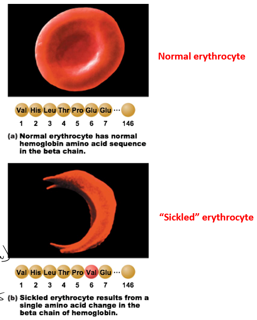 <ul><li><p>erythrocyte deformation</p></li><li><p>genetic condition</p></li><li><p>single point mutation</p><ul><li><p>change in confirmation of protein</p><ul><li><p>different shape and less flexible</p></li><li><p>pulls on cell membrane</p></li></ul></li></ul></li><li><p>Hypoxic condition</p></li><li><p>Circulation problems</p></li><li><p>Can hook together</p><ul><li><p>Forming clots</p></li></ul></li><li><p>Symptoms: pale, short of breath, pain (not enough blood blow), cold hands and feet</p></li><li><p>No cure, treat symptoms</p><ul><li><p>Nitroxide</p></li><li><p>dilate vessels for easier blood flow</p></li></ul></li></ul><p></p>