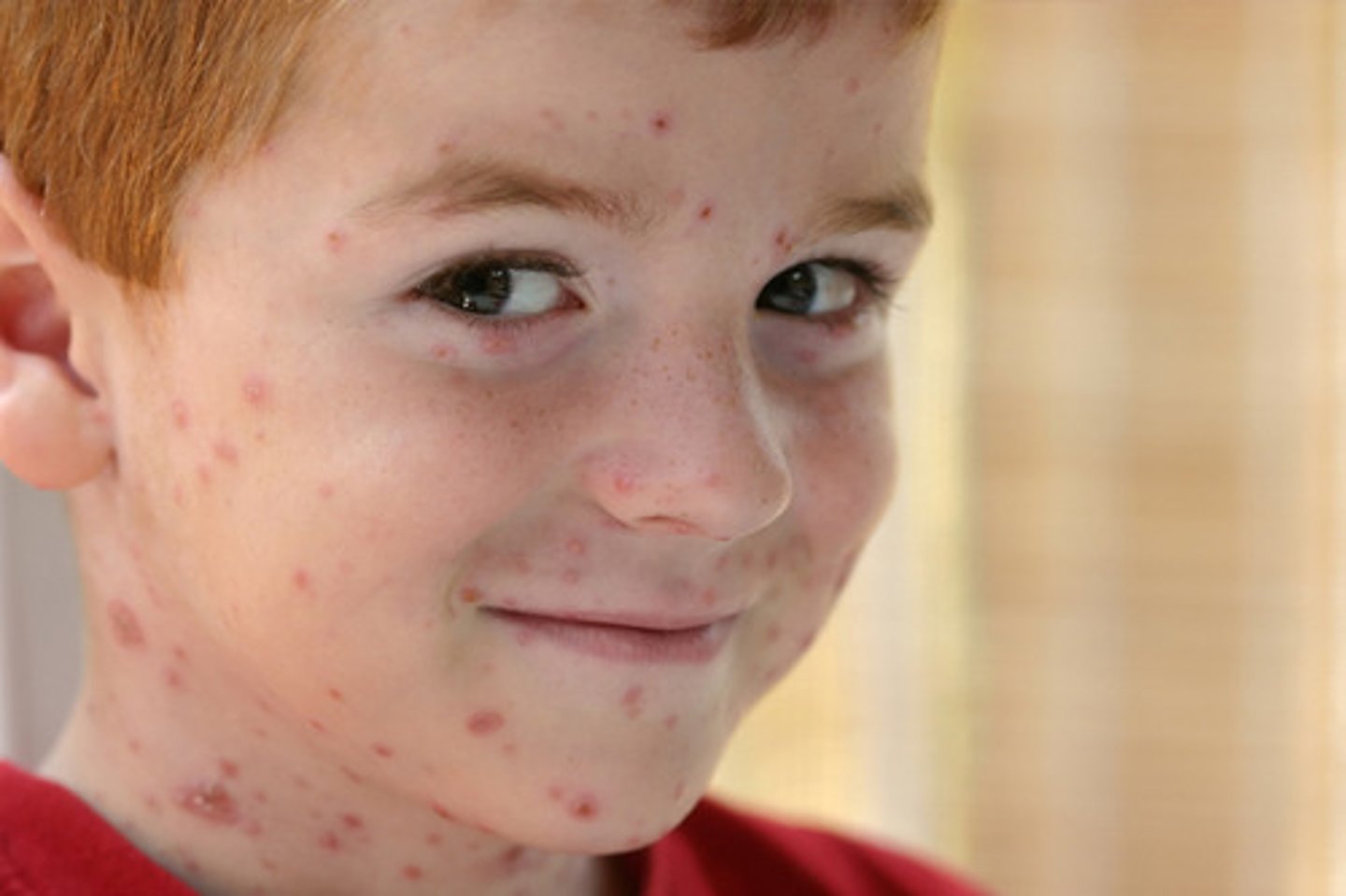 <p>when lesions are crusted over</p>