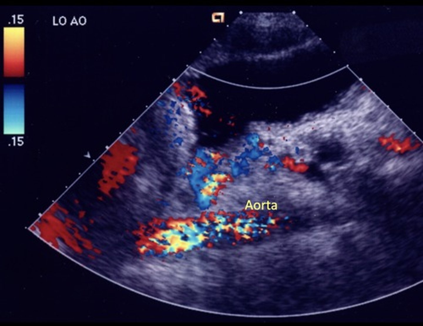 <p>Originate from gastroesophageal junction posterior to left liver lobe</p><p>Due to hepatofugal flow in coronary vein shunt</p><p>High risk of rupture</p>