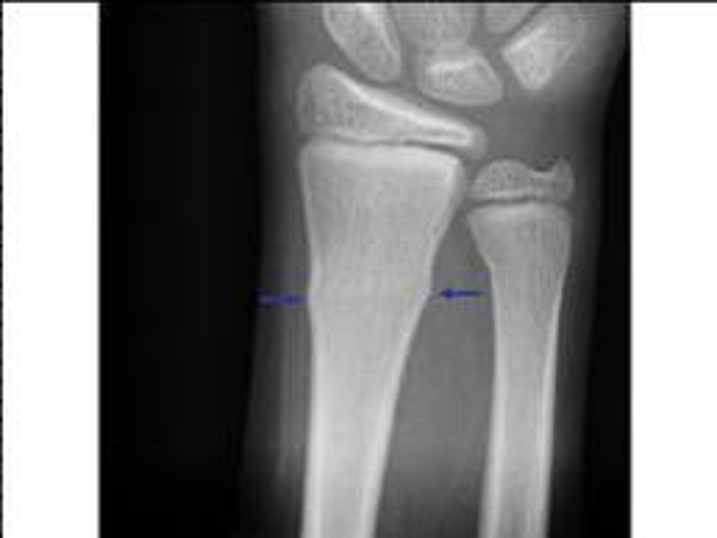 <p>special case, usually only in kids, happens when your bones are softer, bulge out in middle ie from being pushed down at both ends and it buckles/bulges in the middle</p>