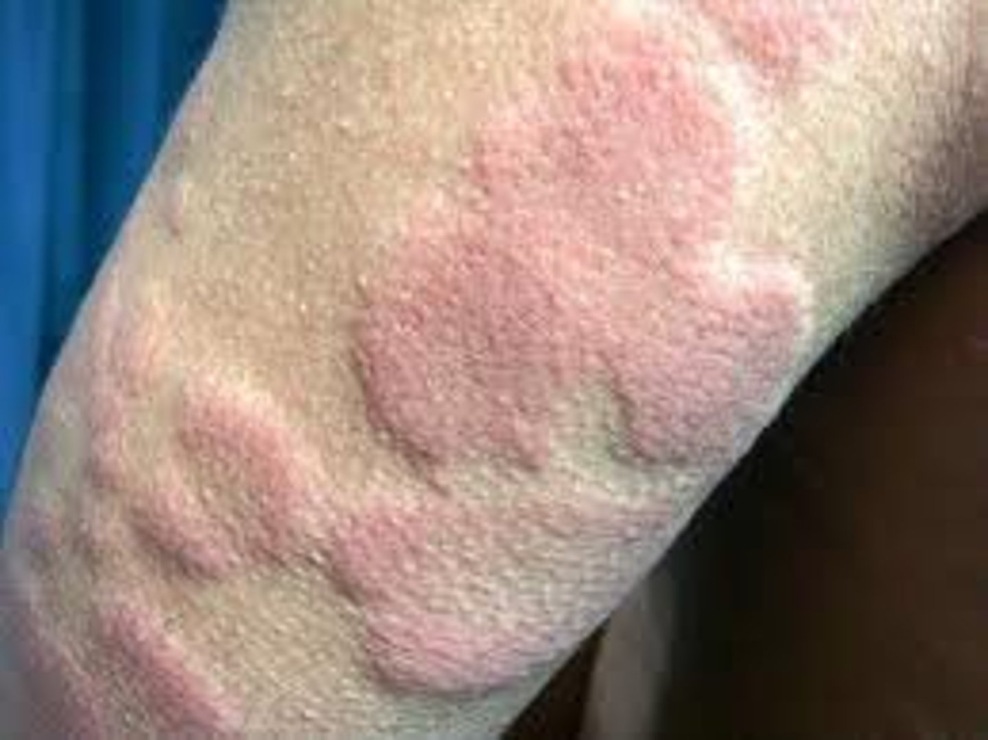 <p>Wheal (primary lesion)</p>
