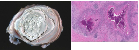 <p>What type of necrosis is this? Causes. Describe the gross and histological appearance. Give example causative agents</p>