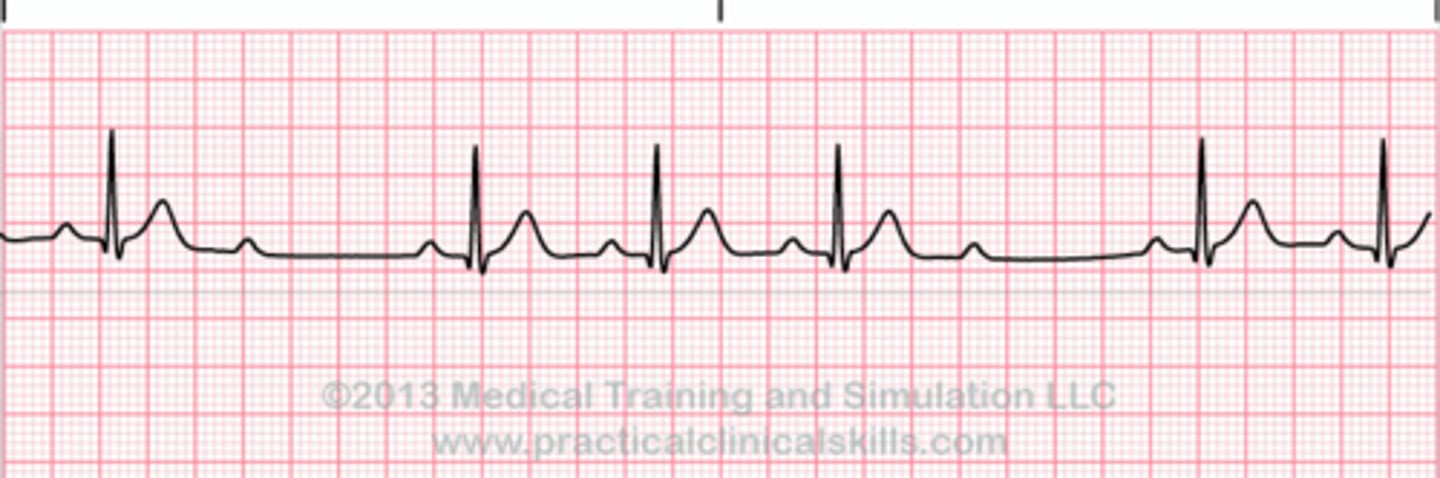 <p>Mobitz type II is a type of second degree atrioventricular block that presents with dropped heartbeats that are not preceded by a change in PR interval length. MOBITZ 2 (some get dropped some get through now you've got mobitz 2)</p>