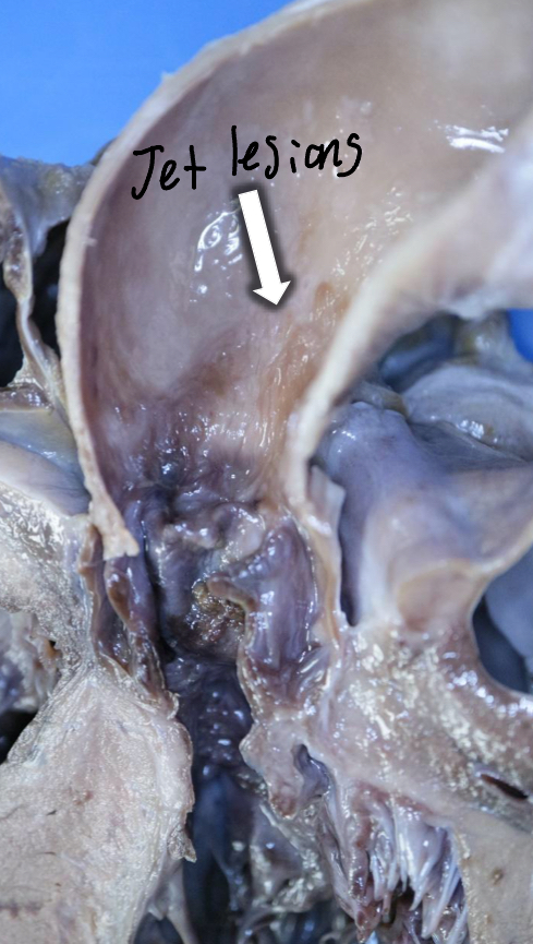 <ul><li><p>Jet Lesions</p><ul><li><p>The result of turbulent blood flow</p></li></ul></li></ul><p></p>