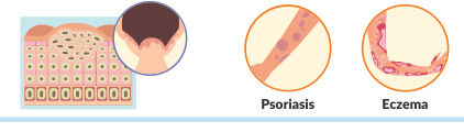 <p><strong>Fast growth of skin cells</strong> that appear in a few small spots looking similar to dandruff.<br>(<strong>Psoriasis &amp; eczema</strong>)</p>