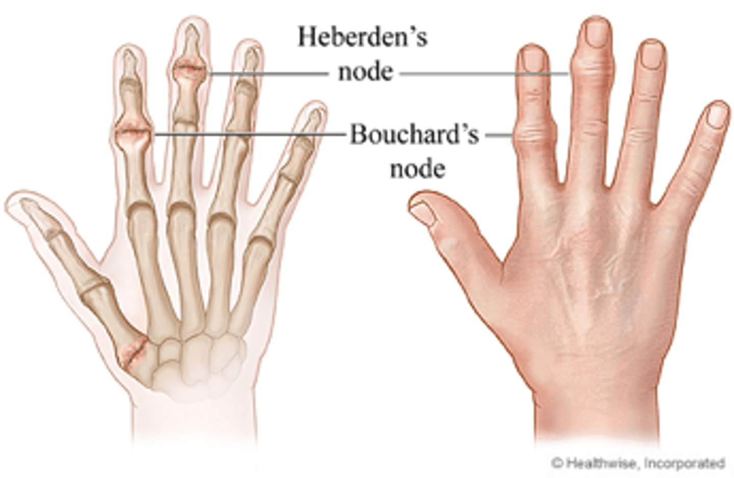 <p>heberden's nodes - DIP</p><p>bouchard's nodes - PIP</p><p>thumb CMC</p>