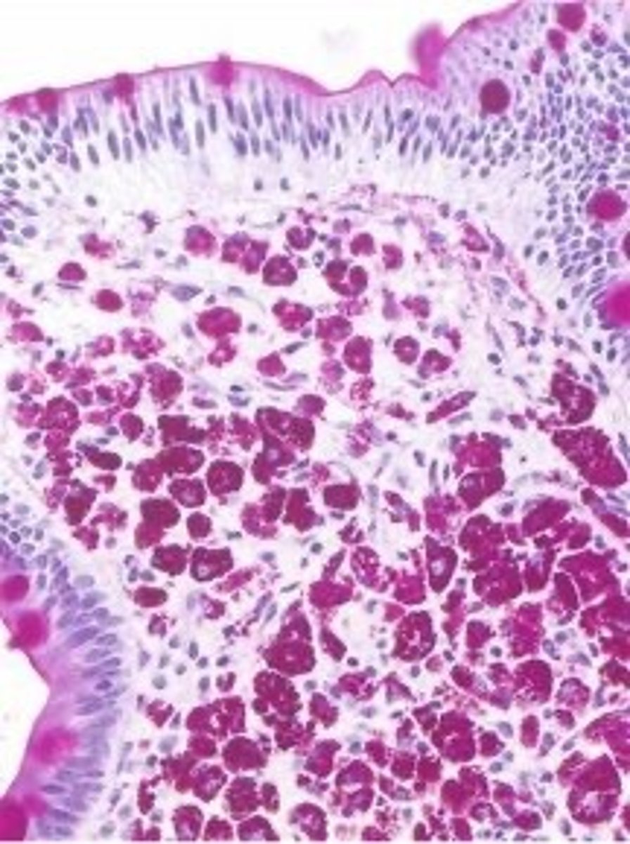 <p>Define Condition:</p><p>Defect of lymphatic transport caused by Systemic infex d/t Tropheryma whipplei</p><p>-Hx:</p><p>&gt; MC in Older Males (40-60 y/o) in Rural Areas</p><p>&gt; NON-AIDS pt (AIDS = MAC)</p><p>-Path: Excess macrophages compressing lymph vessels in small bowel -&gt; Bacteria damage the villi and cause malabsorption -&gt; diarrhea and steatorrhea</p><p>-Sx/PE:</p><p>&gt; Cardiac Isssues</p><p>&gt; Arthralgias</p><p>&gt; Neuro Sx</p><p>-Dx:</p><p>&gt; Biopsy = PAS(+) Foamy (aka "STUFFED") Macrophages in intestinal lamina propria</p>