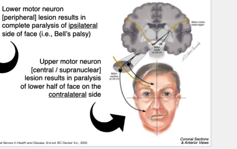 <p><strong>Contralateral lower-face</strong> <span style="color: red;">paralyis</span></p>