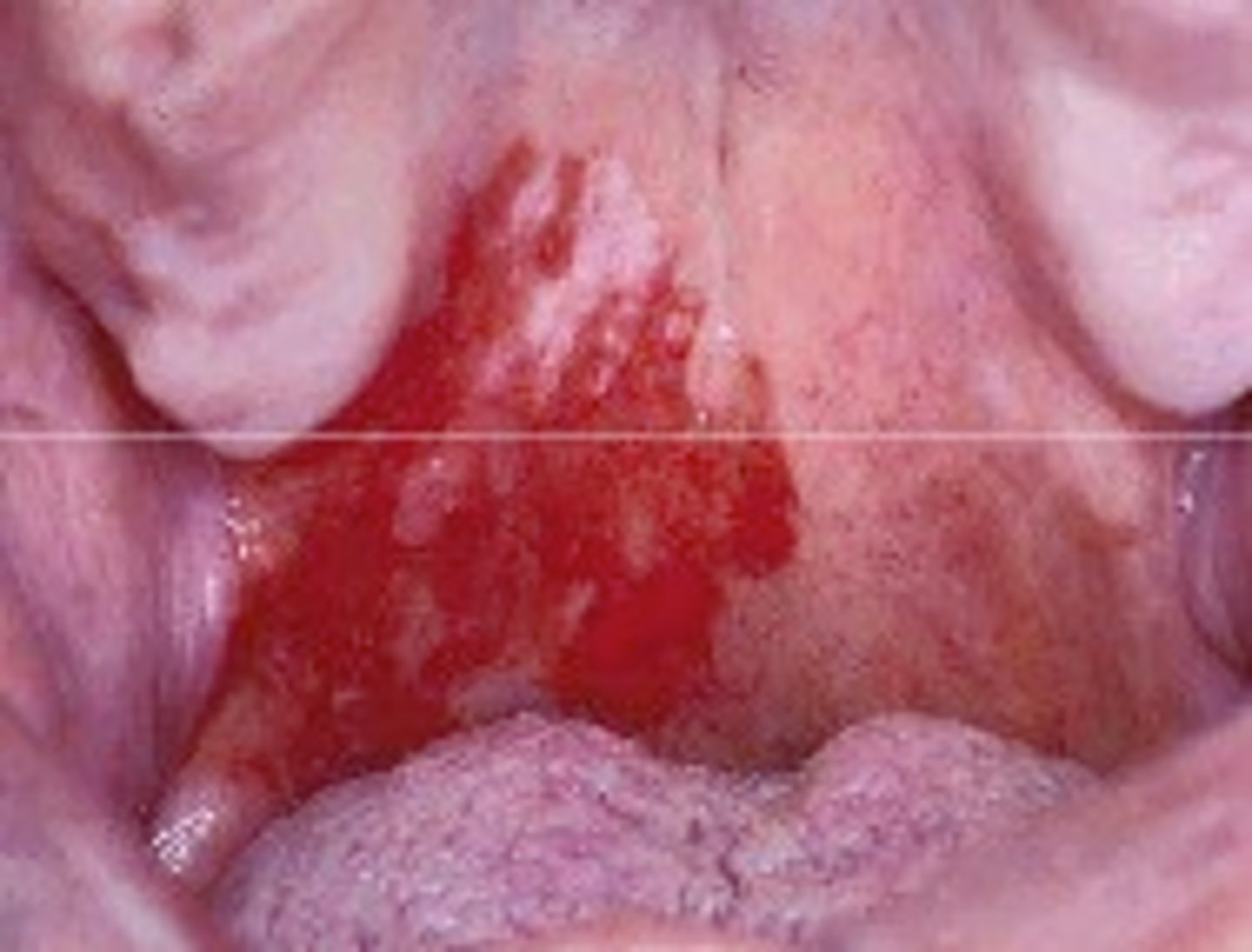 <p>any red patch of tissue in the oral cavity that can signify oral cancer</p>
