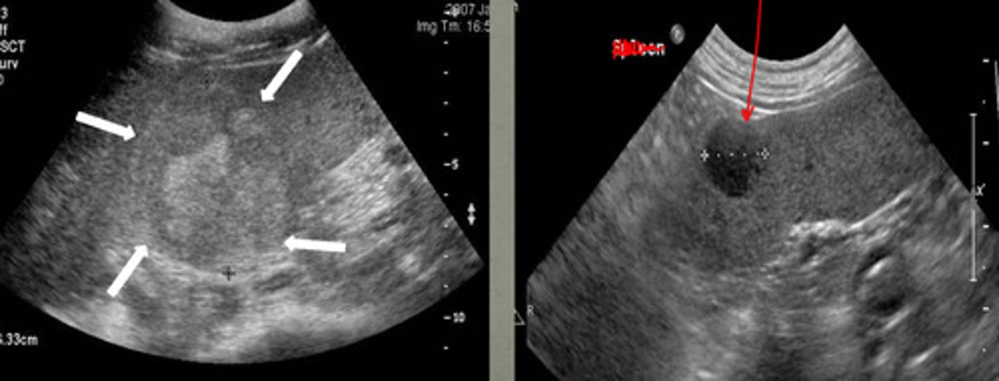 <p>are these ultrasound images of the spleen focal or diffuse?</p>