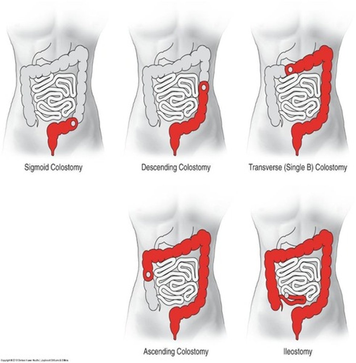 <p>- An opening from the colon (large intestine) created when a portion of the colon or the rectum is removed and the remaining colon is brought to the abdominal wall</p><p>- Required for diverticulitis, ulcerative colitis, cancer, and trauma</p>