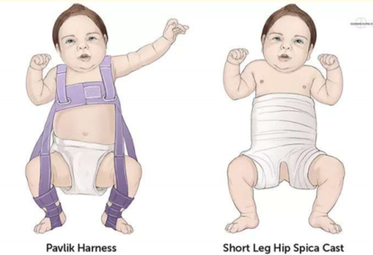 <p>Pavlik harness = this treatment holds the femoral head inside the acetabular fossa and promotes normal fevelopment of the hip joint.</p><p>If this fails, surgery is indicated.</p>