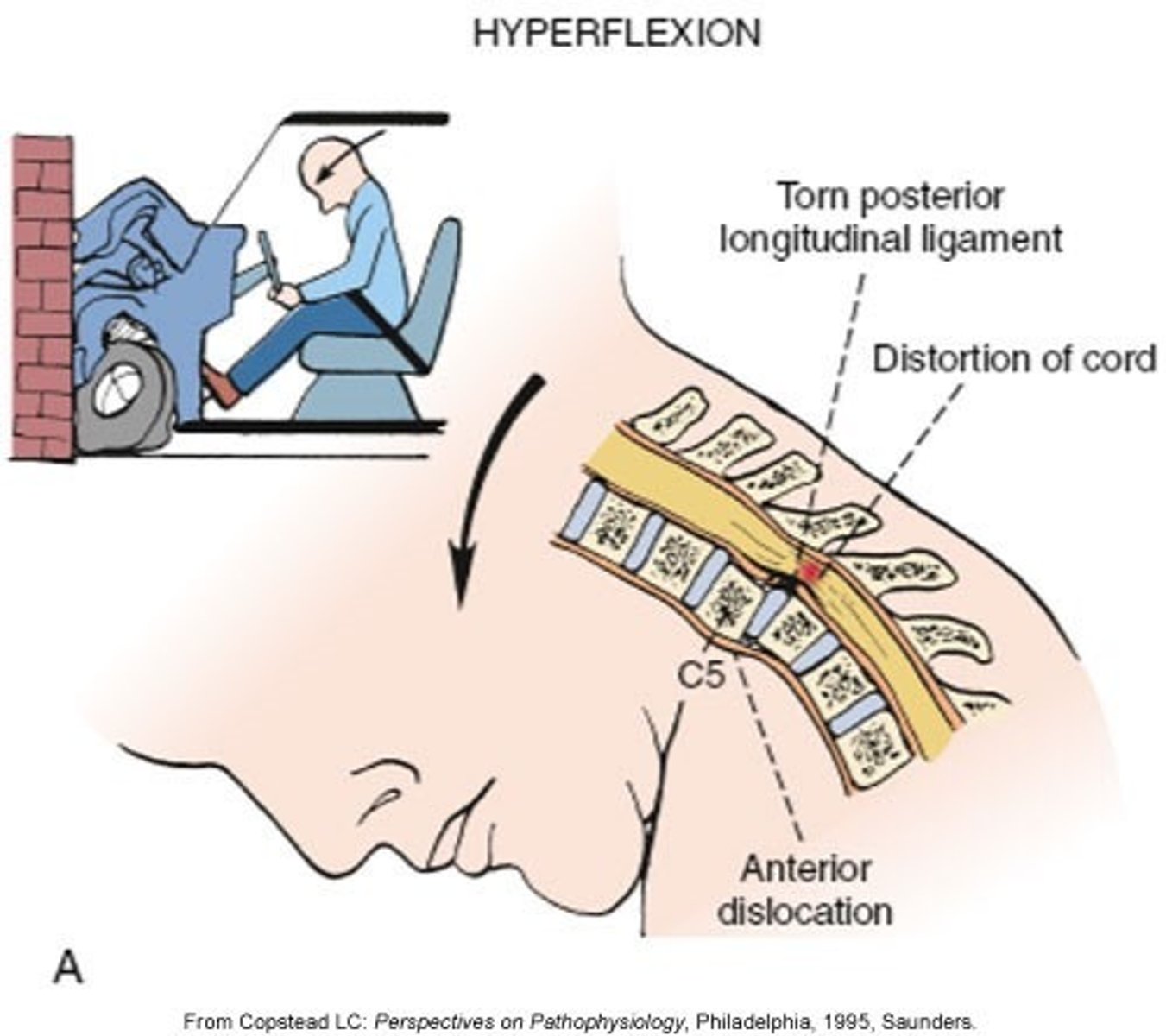 <p>hyperflexion (primary injury)</p>