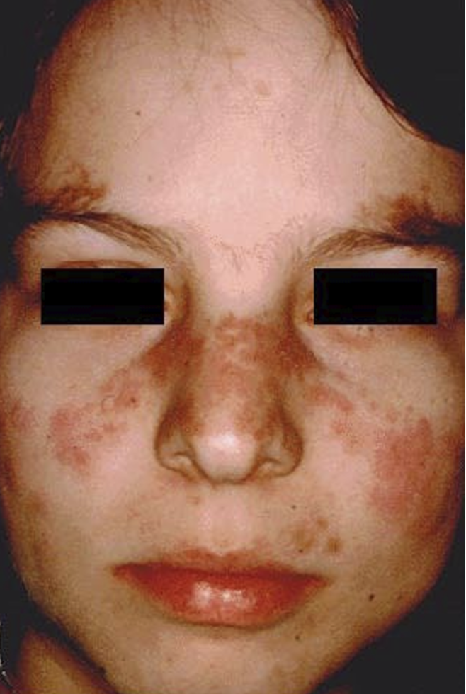 <p>What condition does this patient have</p>