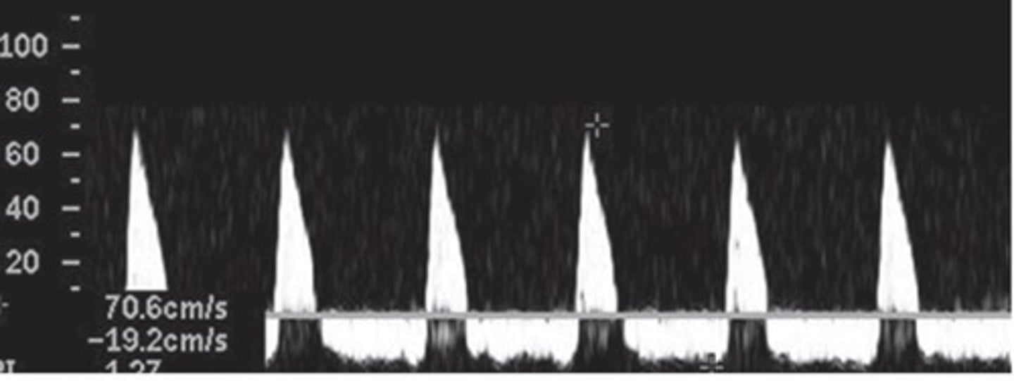 <p>Enlarged kidney</p><p>Enlarged vein with internal echoes</p><p>Lack of color fill</p><p>Biphasic/high resistant arterial signal</p>