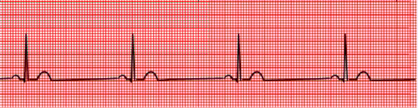 <p>What will sinus bradicardia going to look like on ECG?</p>