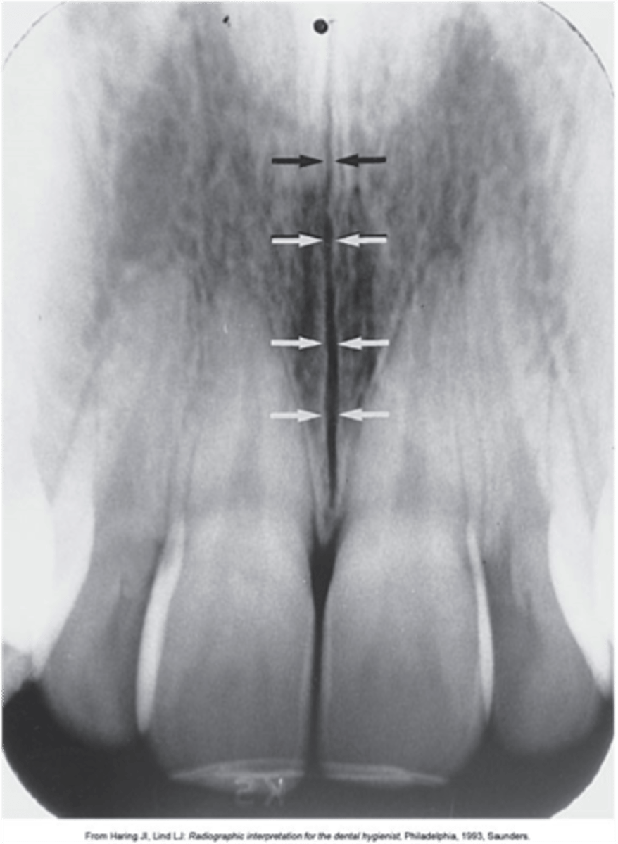 <p>Radiolucent; extends posteriorly through the midline of the palate</p>
