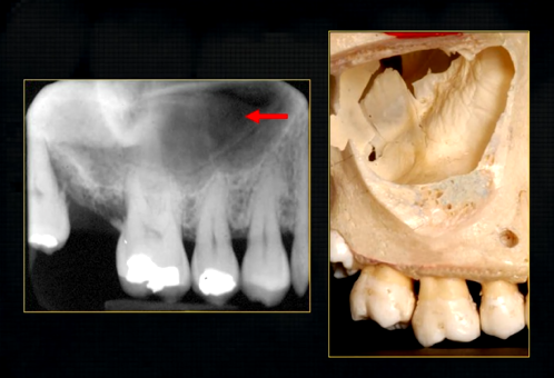 <p>periapical radiograph → posterior maxilla </p>