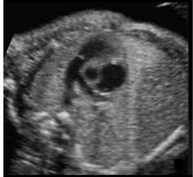 <p>where is <strong>ductus arteriosus</strong></p><ul><li><p>type “MPA-DA-DAo”</p></li></ul><p></p>