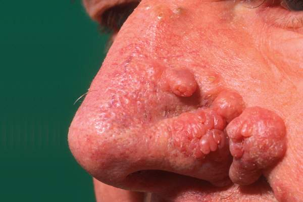 <ul><li><p><span style="line-height: inherit;">Rosacea is characterized by inflammation, pustule formation, and small, red, edematous (swollen, puffy appearance) lines on the skin</span></p></li><li><p><span style="line-height: inherit;">Treatment includes topical antibiotics and, in severe conditions, oral antibiotics</span></p></li></ul><p></p>