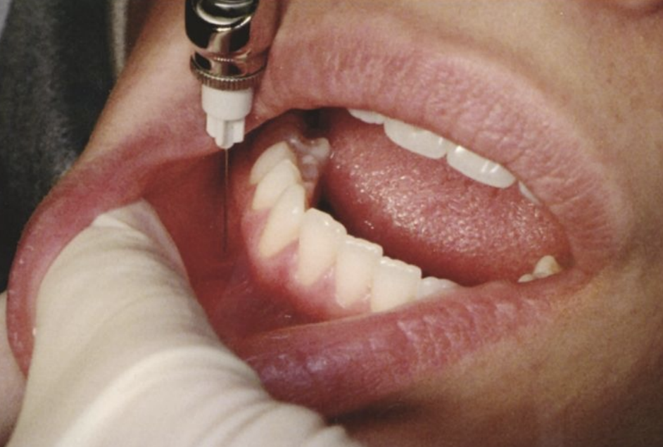 <ul><li><p>Same as mental</p></li><li><p>After injection apply pressure at injection site introrally or extraorally for 2 minutes</p></li></ul><p></p>