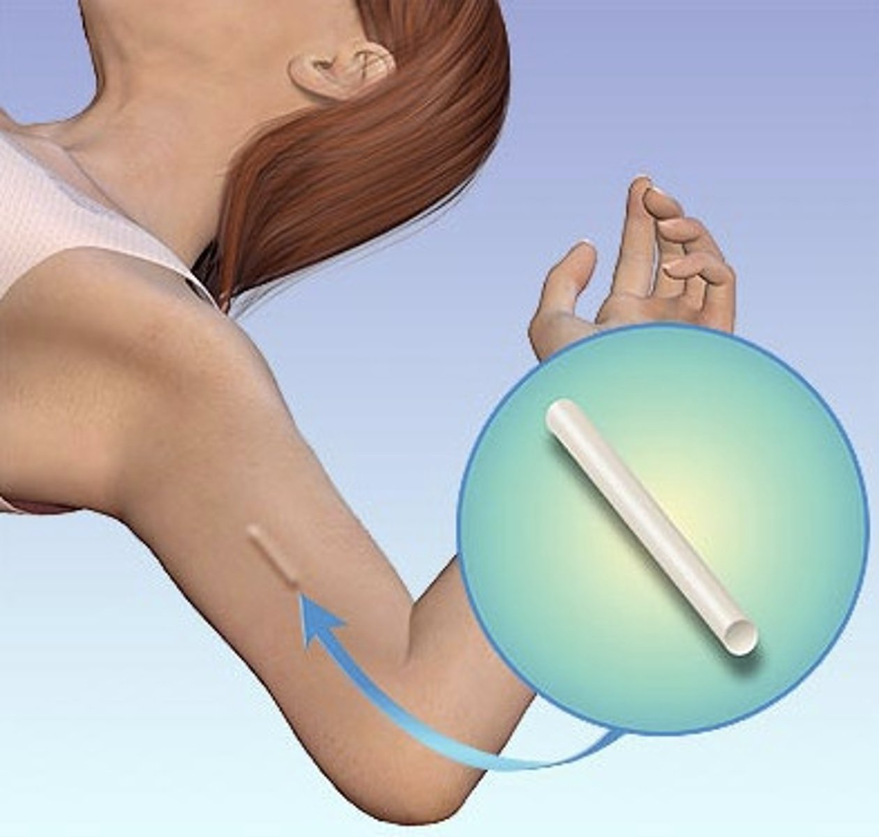 <p>single thin rod that is inserted under the skin of a women's upper arm + rod contains a progestin that is released into the body over 3 years</p>