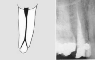 <p><span><span>(1-2)</span></span></p><p><span>one canal leaving the pulp chamber but dividing short of the apex into two separate canals with separate apical foramina</span></p>