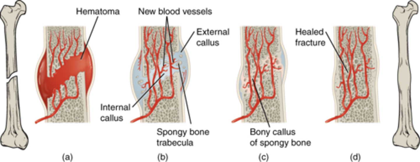 <p>Bony callus formation</p>